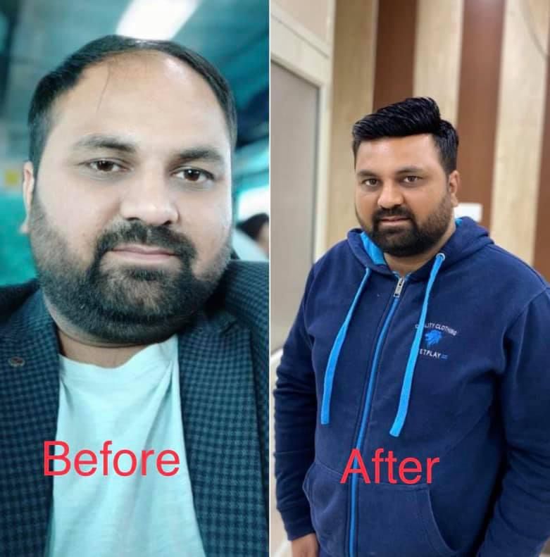 Hair topper installation at Hair Piece Amritsar - Before and after results